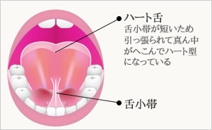 【小児歯科医監修】上唇小帯・舌小帯とは?歯並び・授乳・発音への影響と受診の目安｜みかげ小児歯科・矯正歯科クリニック｜御影