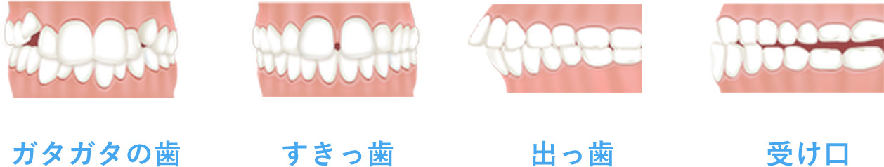 出っ歯・ガタガタ・すきっ歯・受け口