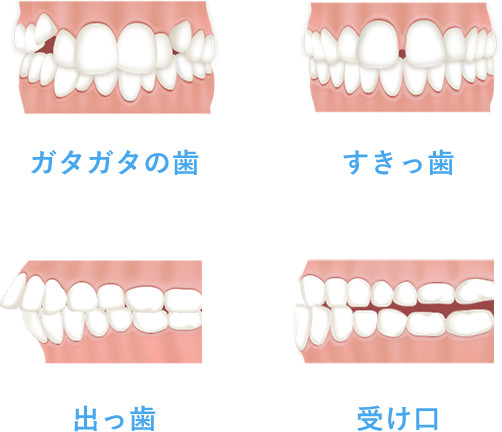 出っ歯・ガタガタ・すきっ歯・受け口